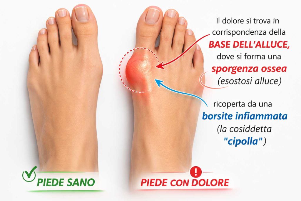 tutore x alluce valgo